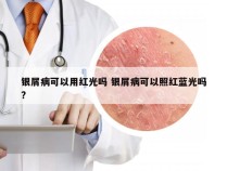 银屑病可以用红光吗 银屑病可以照红蓝光吗?