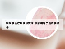 银屑病治疗后皮肤变薄 银屑病好了后皮肤样子