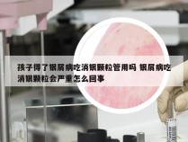 孩子得了银屑病吃消银颗粒管用吗 银屑病吃消银颗粒会严重怎么回事