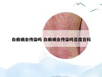 白癣病会传染吗 白癣病会传染吗百度百科