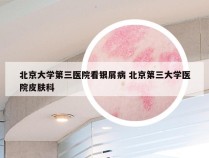 北京大学第三医院看银屑病 北京第三大学医院皮肤科