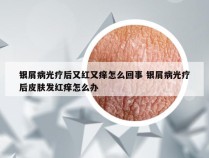 银屑病光疗后又红又痒怎么回事 银屑病光疗后皮肤发红痒怎么办