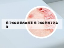 脑门长白斑是怎么回事 脑门长白色癣了怎么办