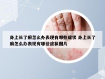 身上长了癣怎么办表现有哪些症状 身上长了癣怎么办表现有哪些症状图片