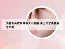 为什么头皮长钱币大小的癣 头上长了头皮癣怎么办