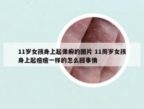 11岁女孩身上起像癣的图片 11周岁女孩身上起痘痘一样的怎么回事情