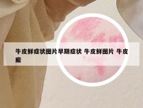 牛皮鲜症状图片早期症状 牛皮鲜图片 牛皮廨