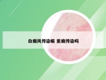 白癜风传染嘛 紫癜传染吗