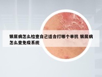 银屑病怎么检查自己适合打哪个单抗 银屑病怎么查免疫系统