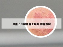 膝盖上长癣膝盖上长癣 膝盖有癣