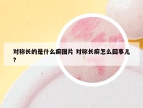 对称长的是什么癣图片 对称长癣怎么回事儿?