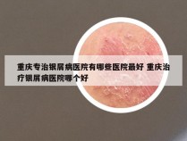 重庆专治银屑病医院有哪些医院最好 重庆治疗银屑病医院哪个好