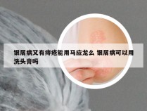 银屑病又有痔疮能用马应龙么 银屑病可以用洗头膏吗