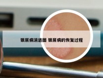 银屑病消退图 银屑病的恢复过程