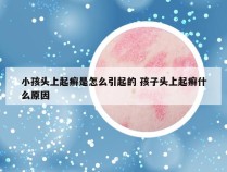 小孩头上起癣是怎么引起的 孩子头上起癣什么原因