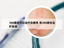 308激光可以治疗白癜风 有308激光治疗白斑