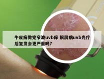 牛皮癣做完窄波uvb痒 银屑病uvb光疗后复发会更严重吗?