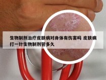 生物制剂治疗皮肤病对身体有伤害吗 皮肤病打一针生物制剂管多久