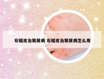 石榴皮治银屑病 石榴皮治银屑病怎么用