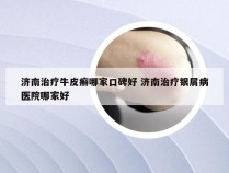 济南治疗牛皮癣哪家口碑好 济南治疗银屑病医院哪家好