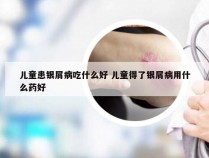 儿童患银屑病吃什么好 儿童得了银屑病用什么药好