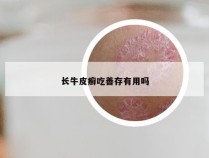 长牛皮癣吃善存有用吗