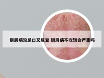 银屑病没忌口又反复 银屑病不吃饭会严重吗