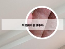 牛皮癣母乳没事吗