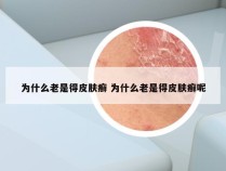 为什么老是得皮肤癣 为什么老是得皮肤癣呢