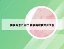 阴囊癣怎么治疗 阴囊癣症状图片大全