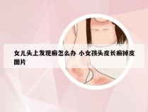 女儿头上发现癣怎么办 小女孩头皮长癣掉皮图片