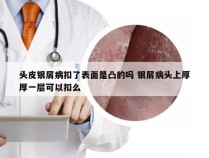 头皮银屑病扣了表面是凸的吗 银屑病头上厚厚一层可以扣么