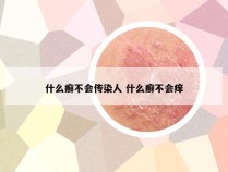 什么癣不会传染人 什么癣不会痒