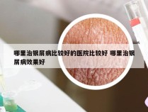 哪里治银屑病比较好的医院比较好 哪里治银屑病效果好