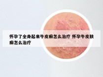 怀孕了全身起来牛皮癣怎么治疗 怀孕牛皮肤癣怎么治疗