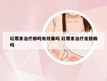 红霉素治疗癣吗有效果吗 红霉素治疗皮肤癣吗