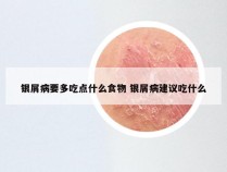 银屑病要多吃点什么食物 银屑病建议吃什么