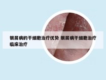 银屑病的干细胞治疗优势 银屑病干细胞治疗临床治疗