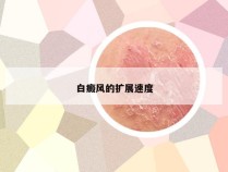 白癜风的扩展速度