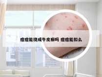 痘痘能挠成牛皮癣吗 痘痘能扣么