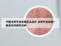 中医点状牛皮皮癣怎么治疗 点状牛皮皮癣一般多长时间可以好