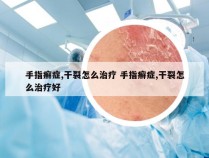 手指癣症,干裂怎么治疗 手指癣症,干裂怎么治疗好