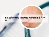 银屑病白印凸起 银屑病留下黑印好还是白印好