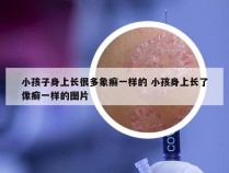 小孩子身上长很多象癣一样的 小孩身上长了像癣一样的图片