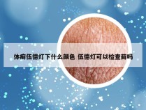 体癣伍德灯下什么颜色 伍德灯可以检查藓吗