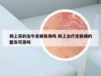 网上买的治牛皮癣有用吗 网上治疗皮肤病的医生可靠吗