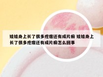 娃娃身上长了很多疙瘩还有成片癣 娃娃身上长了很多疙瘩还有成片癣怎么回事