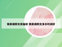 银屑病照光有辐射 银屑病照光多长时间好