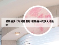 银屑病多长时间能看好 银屑病大概多久才能好