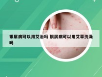 银屑病可以用艾治吗 银屑病可以用艾草洗澡吗